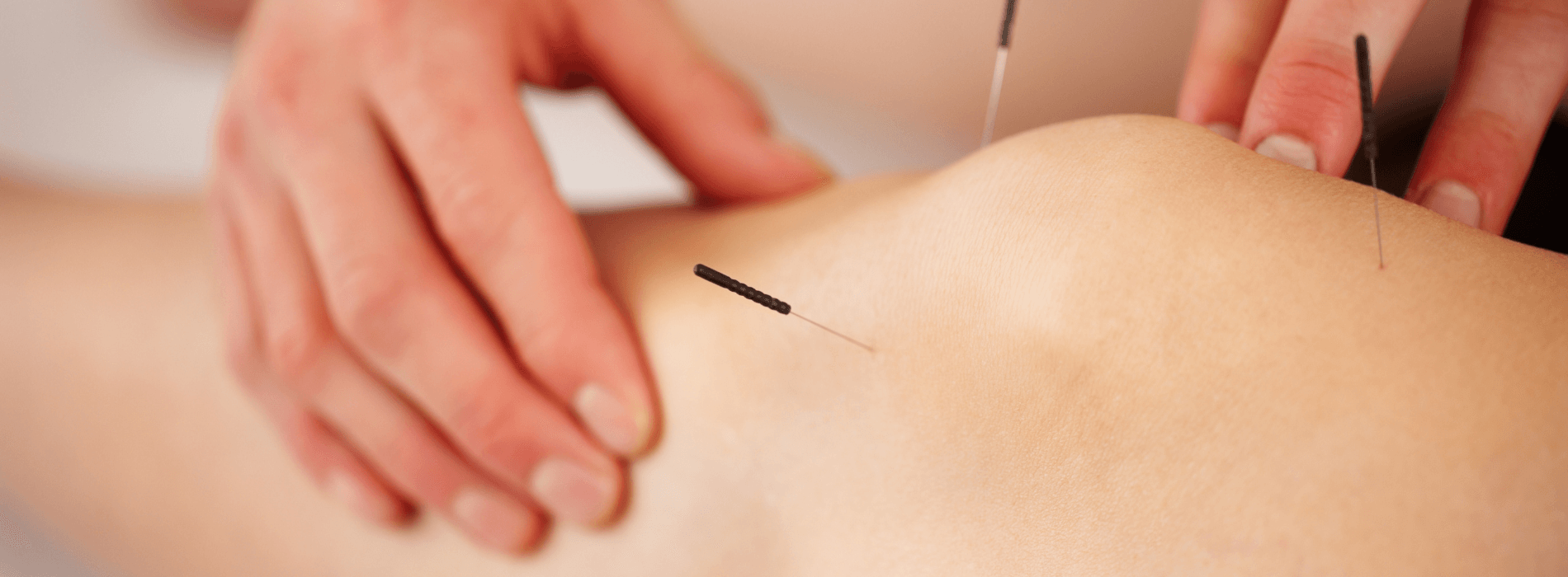 Acupuncture Arthrose du Genou : Une Solution Naturelle et Efficace